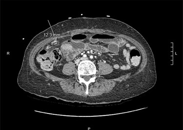 Computerized tomography of the abdomen and pelvis demonstrating appendiceal and peritoneal thickening.