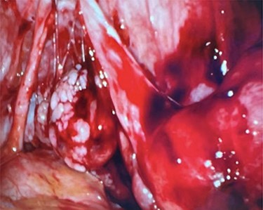 Right ovary with papillary excrescences and grossly abnormal appendix.