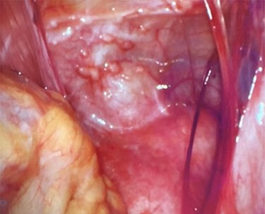 Abdominal wall anterior to the uterus with scattered peritoneal nodules.