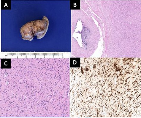 (A) The outer surface of the appendix was smooth to slightly rough with cauterized fibrous adhesions. (B) The appendiceal wall was diffusely expanded by an irregular spindle cell proliferation involving the mucosa, submucosa and muscularis propria. A tiny lumen was identified in this section, but the other sections showed completely obliterated central lumen, mimicking fibrous obliteration. (C) High-power view of spindle cells in the muscularis propria demonstrated wavy dark nuclei. (D) Spindle cells were positive for S100.