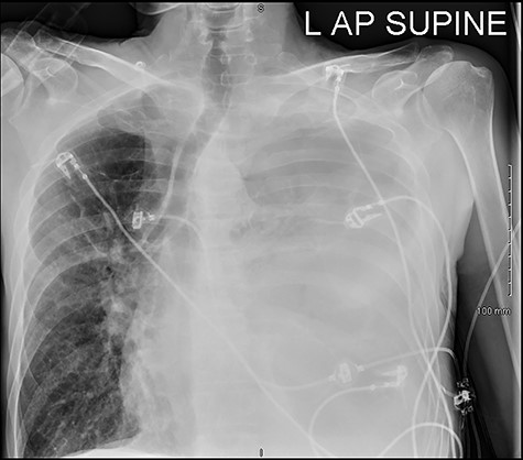 Complete opacification of left hemithorax with mass effect.