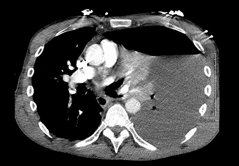 Massive haemopneumothorax on CT.