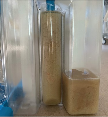 Increased sedimentation post enteral feeding.