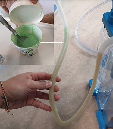 Positive dye test with green ice cream.