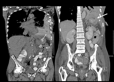 (Left) Contrast in stomach and pleural fluid are iso-dense confirming a fistula; (Right) neck of hernia in the diaphragm.