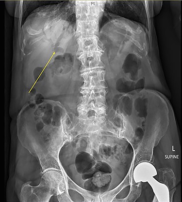 Abdominal X-ray with arrow demonstrating pneumobilia.