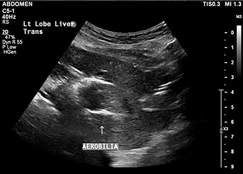 Abdominal ultrasound demonstrating pneumobilia.