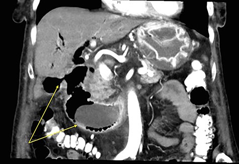 Coronal CT image of abdomen with arrows demonstrating a fistulous connection between the gallbladder and duodenum, and a large gallstone in the second part of the duodenum.