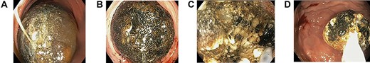 (A) Large gallstone in the second part of the duodenum on endoscopy causing complete obstruction, (B) minimal effect of electrohydraulic lithotripsy seen on the gallstone, (C) breakdown of the gallstone using Holmium laser lithotripsy, (D) mobilization of gallstone fragment into pylorus after lithotripsy.