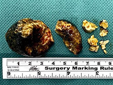 Multiple gallstone fragments retrieved during laparotomy measuring up to 4 cm in diameter.