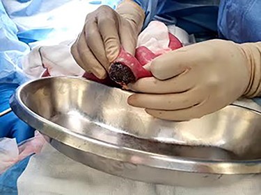 Large gallstone fragment retrieved through enterotomy in the small bowel.