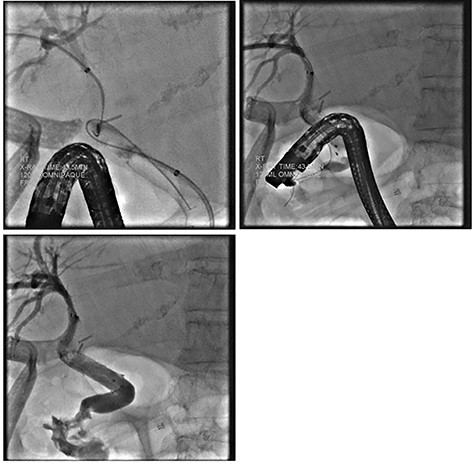 ERCP demonstrating successful rendezvous with deployment of metal stent in the vicinity of surgical drain.