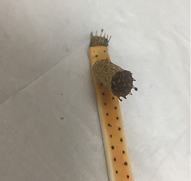 Explanted metal biliary stent deployed through surgical drain lumen.