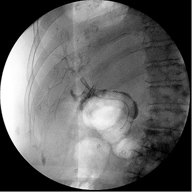 ERCP demonstrating successful replacement of metal stent after explantation.