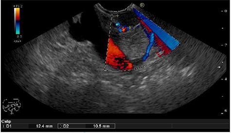 Hypoechogenic round shape tumor in the head of pancreas (between two marks)–EUS.