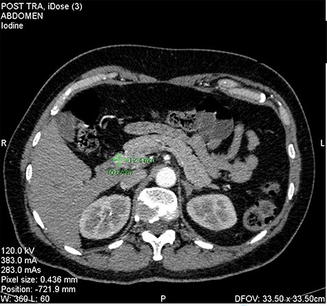 Insulinoma in the head of the pancreas—CT picture in arterial phase (as shown green marks).