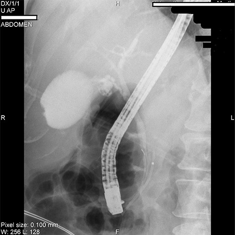 ERCP picture of inserted stents in pancreatic (near the arrow) and bile duct.
