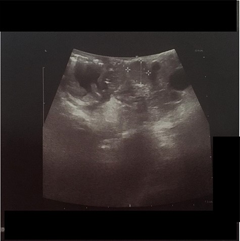 IOUS (intraoperative ultrasound) performed during surgery shown hypoechogenic lesion in the head of pancreas (between white marks).