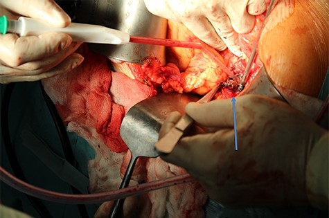 Enucleation of insulinoma by using of harmonic skalpel (arrow shows enucleated insulinoma).