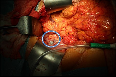 Pancreatic defect after enucleation of insulinoma filled with tissue glue (in the circle).