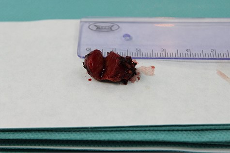 Enucleated insulinoma cross sectional image.