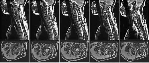 Sagittal (A-E) and axial (F-J) images of T2-weighted MRI of the cervical spine showing a left-sided extradural heterogeneously high T2-signal intensity lesion at C3–C6, causing compressing on the adjacent spinal cord. The lesion is containing multiple small vessels, extending through the left C4–C5 foramina. It measures 4.9 x 4.7 x 1.6 cm in maximum craniocaudal, transverse and anterior–posterior dimensions. The lesion is corresponding with arteriovenous fistula. There is evidence of bony outgrowth of C4 right facet join, contributing to the mass effect on the spinal cord. There is fat hypertrophy involving the posterior right neck, corresponding to the upper limb infiltrative lesion (F-J).
