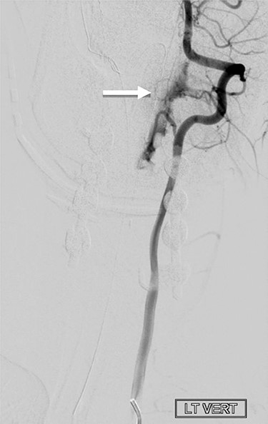 Cerebral angiography, with left vertebral artery injection, demonstrates evidence of arteriovenous shunting. The lesion is suggestive of arteriovenous fistula in the left upper cervical region. The arterial supply, from a hypertrophied branch of the left vertebral artery, was arising at the level of C2. However, the fistulous connection was at the level of C3 and C4.