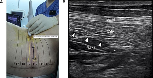 The TAP block. (A) The linear transducer was placed transversely on the lateral abdominal wall at the left midaxillary line between the subcostal margin and the iliac crest. (B) Ultrasound view showing a local anesthetic solution (asterisk) injected and spread into the plane between the IOM and TAM. EOM: external oblique muscle, IOM: internal oblique muscle, TAM: transversus abdominis muscle.