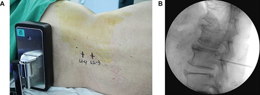 The lumboperitoneal shunt surgery. (A) Initial dermal marking made on the patient’s back at the interspinal space of L2–3 and L3–4. (B) Tuohy needle was advanced toward the target near the lower border of the L3 vertebral body under fluoroscopic guidance.