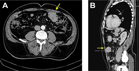 CT images showing a nodular lesion with 48 × 57 × 44 mm, close to the anterior abdominal wall (yellow arrow).