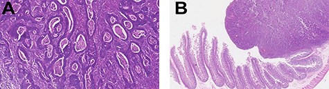 Histopathology examination revealed invasive adenocarcinoma moderately differentiated of small bowel. The lesion invaded almost all tunica muscularis with little stromal desmoplastic reaction and moderate polymorph inflammatory response (left—H&E 20×; right—H&E 1.25×). There was no evidence of lymphatic or venous invasion. Of the five lymph nodes examined, no metastasis were found. Free surgical margins were achieved.