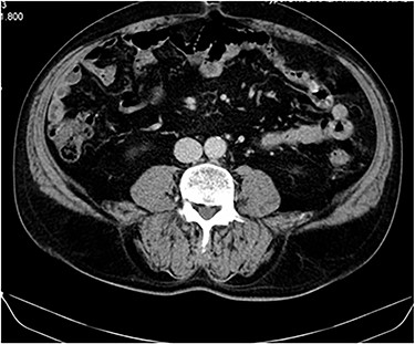CT image at 1-year follow up showing no local tumor recurrence.