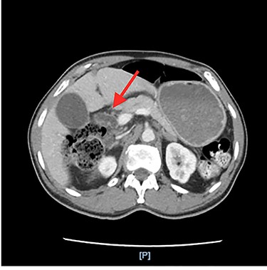 Dilated common bile duct on CT abdomen/pelvis.