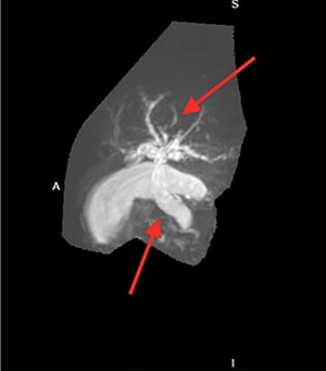 Intrahepatic and extrahepatic biliary ductal dilatation.