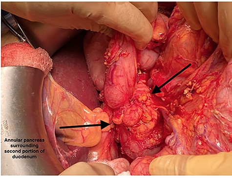 Annular pancreas encircling the pylorus and the first and section portions of the duodenum.