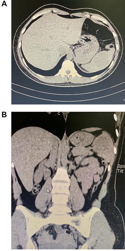 (A) CT, a mass is seen in the spleen. (B) CT, the enlarged spleen with the mass in the upper pole.