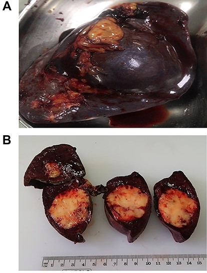 (A) Spleen completely resected. (B) White SANT masses within the spleen.