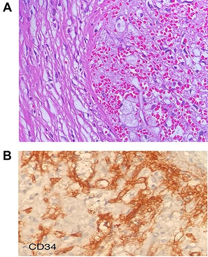 (A) Multiple angiomatoid nodules embedded in a fibrosclerotic stroma. (B) CD34 were detected on microscopic evaluation on the stroma.