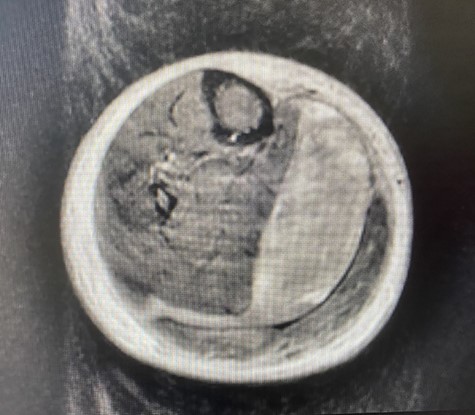 MRI of the RLE showing hematoma in the superficial posterior compartment.