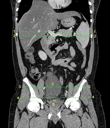Coronal section of a contrast-enhanced CT scan of the abdomen, showing the mesenteric cyst (C) situated on the superior aspect of the urinary bladder (B). The number pairs indicate the transverse section images displayed in Figs. 2–5.
