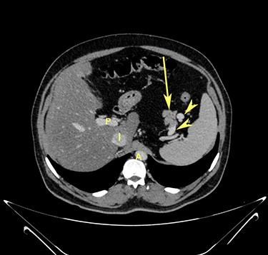 Transverse section image of a contrast-enhanced CT scan of the abdomen at level 1–1 (Fig. 1), showing the pancreas’ normal tail (long arrow). Splenic vessels are labelled using arrowheads.