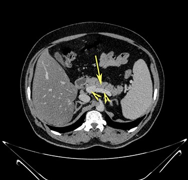 Transverse section image of a contrast-enhanced CT scan of the abdomen at level 2–2 (Fig. 1), showing the pancreas’ normal head and body (long arrow). The confluence of the splenic vein and portal vein are labelled using arrowheads.