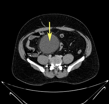 Transverse section image of a contrast-enhanced CT scan of the abdomen at the level 3–3 (Fig. 1), showing a solitary cyst (arrow) with a non-enhancing wall separate from the intestines.