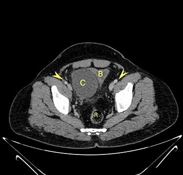 Transverse section image of a contrast-enhanced CT scan of the abdomen at the level 4–4 (Fig. 1), showing a solitary cyst (C) with a non-enhancing wall separate from the urinary bladder (B). Iliac vessels are labelled with arrowheads.