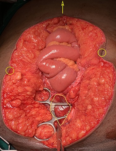 Laparotomy image showing an intraperitoneal cyst in the pelvis (irregular outline), free from the umbilicus (circles) and the intestines. Arrow points towards xiphisternum.