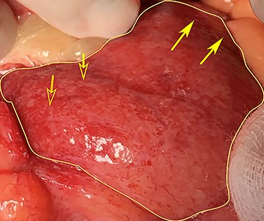 Laparotomy image of the anterior wall of the cyst (irregular outline) showing haemorrhage (open arrows) and infarct (closed arrows).