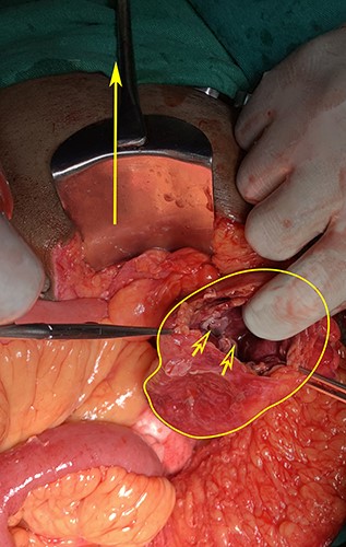 Laparotomy image showing the cyst opened anteriorly (irregular outline), inner aspect of opened cyst showing a blackened gangrenous appearance (open arrows). The filled arrow points to the pubic symphysis.