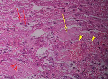Histopathology (haematoxylin and eosin staining) of the cyst wall (higher magnification) shows haemorrhage (red arrowhead), vascularity (yellow arrowhead), mononuclear inflammatory cells (red arrow) and collagen (yellow arrow).
