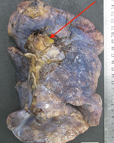 The left lung specimen resected en-bloc with the lesion clearly within the staple line and margins of the pulmonary artery.