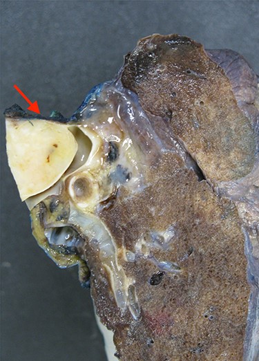 A large cross-section of the specimen demonstrating the significant intravascular obstruction caused by the angiofibromatoid histiosarcoma.
